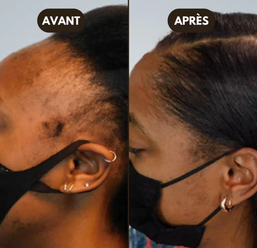 Roll Grow™ – Sérum Anti-Alopécie & Repousse Tempes Dégarnies